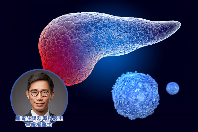 揭胰臟癌可怕真相 發病數字不入十大 死亡數字排第四! - 中年好健康 Stay Healthy